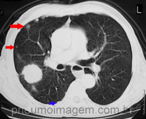 PARAR DE FUMAR AP�S O DIAGN�STICO DO C�NCER DE PULM�O REDUZ A PROGRESS�O E A MORTALIDADE PELA DOEN�A